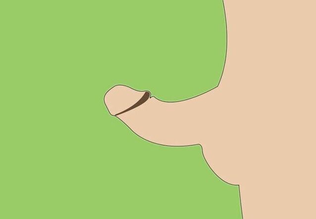 varpos kreivumas kaip chirurginio padidinimo indikacija